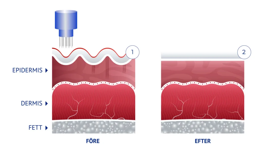 Ge huden nytt liv med Mesoterapi